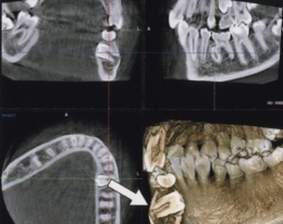 埋伏歯の診断.JPG